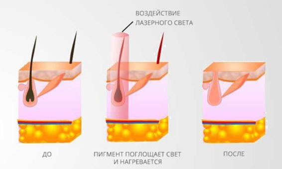 Воздействие лазерного света